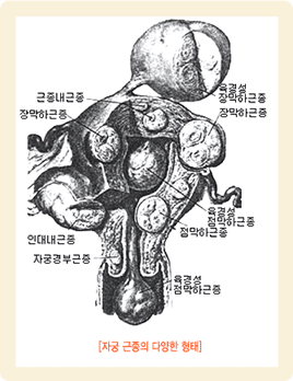 자궁근종 발생부위